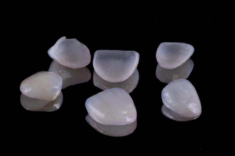 Picture of dental veneers in Philadephia