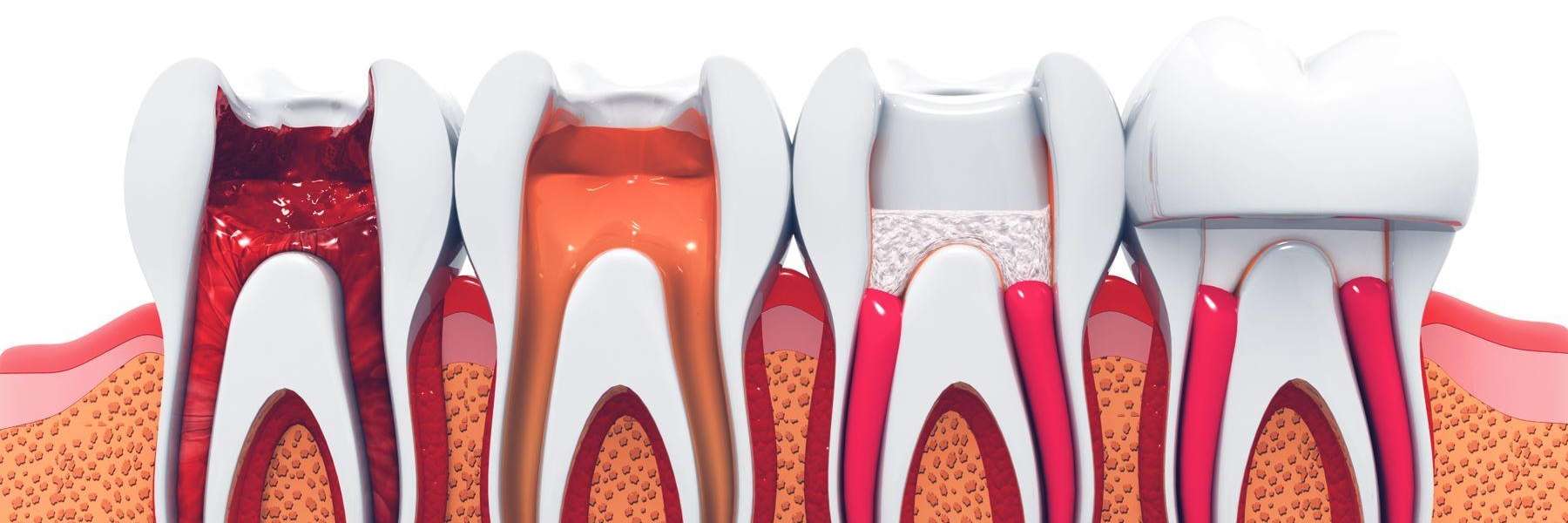Model of teeth with root canals specialist at the Philadelphia Dentist